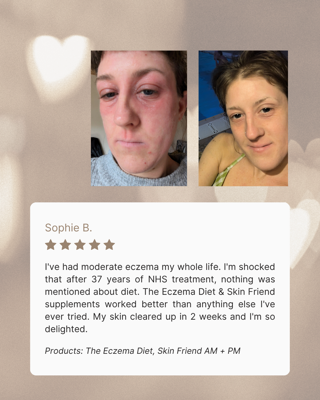 Before and after comparison of a person with eczema, featuring a review from Sophie B. on a beige background.