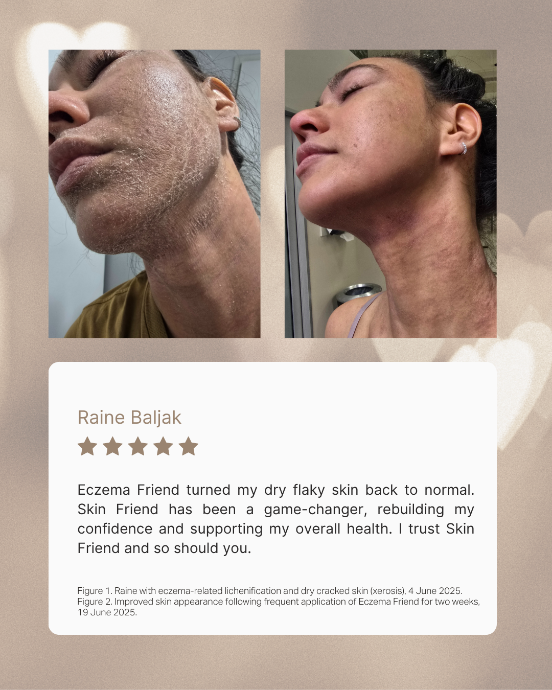 Before and after comparison of skin condition with a review from Raine Bajjak on a beige background.