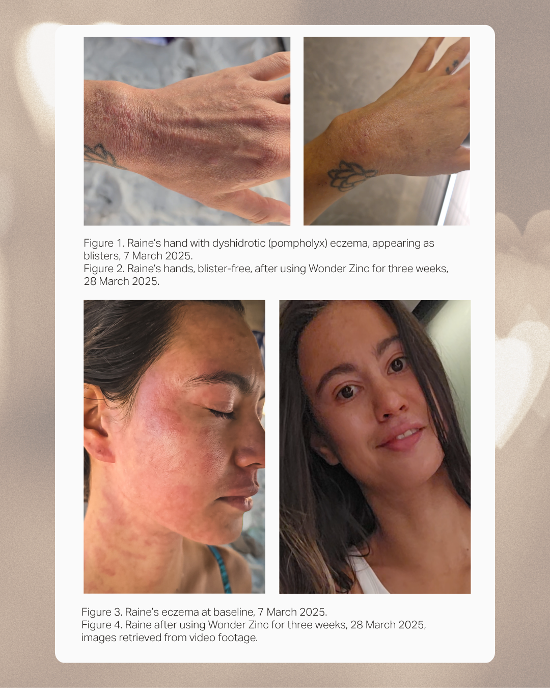 Wonder Zinc | Rash Cream