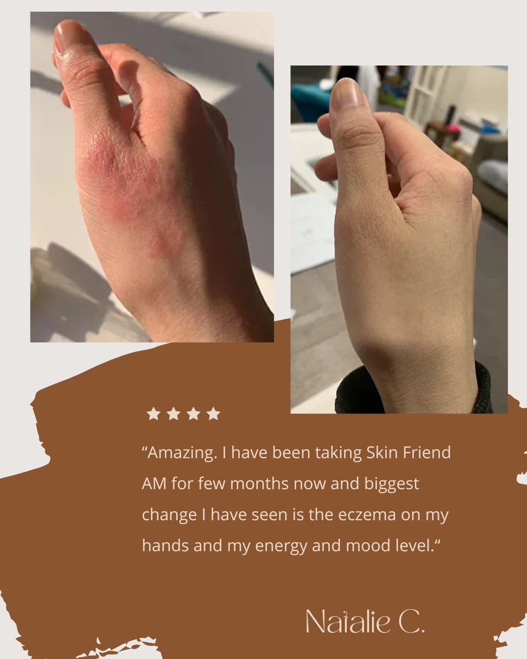 Hand with eczema and comparison to a normal hand, with a testimonial about using Skinfriend AM.
